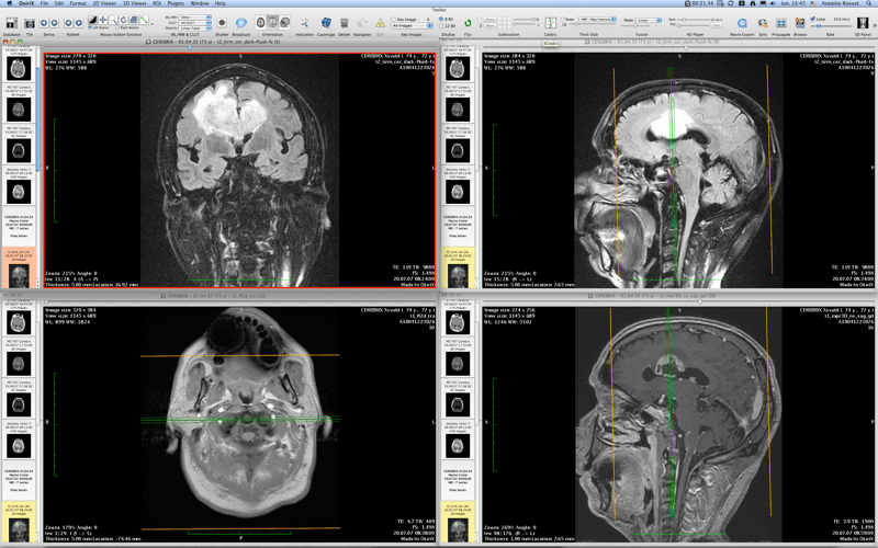 Osirix1